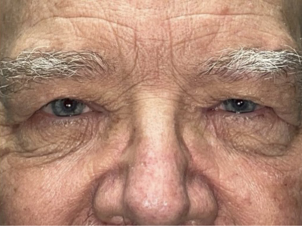 Brow/Forehead Lift
