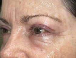 Upper Lid Blepharoplasty (upper eyelid lift)