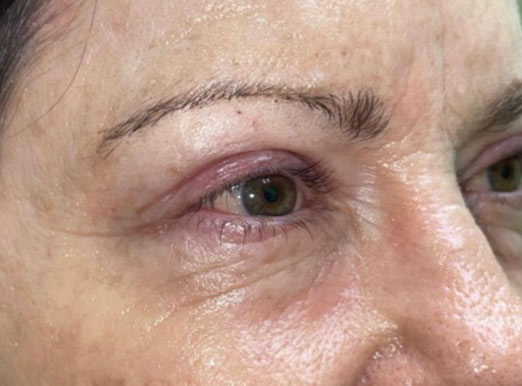 Upper Lid Blepharoplasty (upper eyelid lift)
