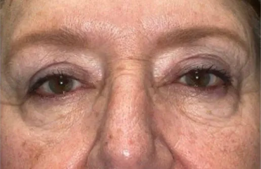 Upper Lid Blepharoplasty (upper eyelid lift)