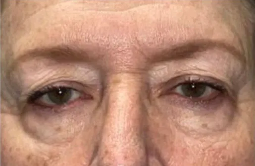 Upper Lid Blepharoplasty (upper eyelid lift)