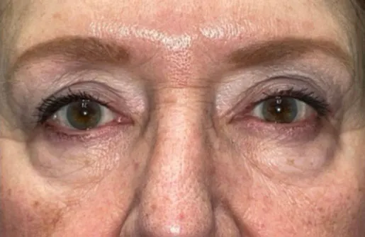Upper Lid Blepharoplasty (upper eyelid lift)