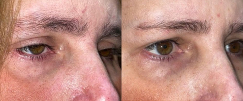 Before/After Aquired Ptosis Surgery Acquired Ptosis patient 2 before after photos 1