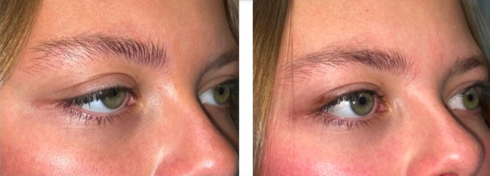 Before/After Aquired Ptosis Surgery Acquired Ptosis patient 3 before after photos