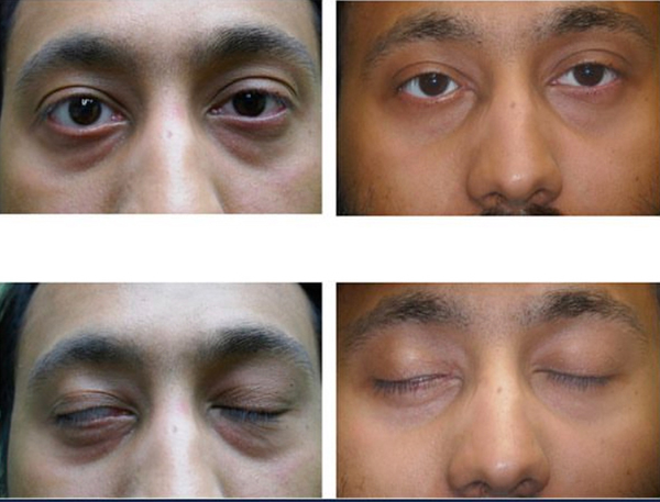 Congenital Ptosis Before And After Congenital Ptosis before and after