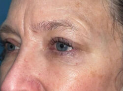 Eyelid Lift (blepharoplasty/ptosis repair)