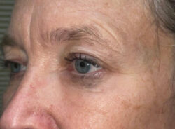 Eyelid Lift (blepharoplasty/ptosis repair)
