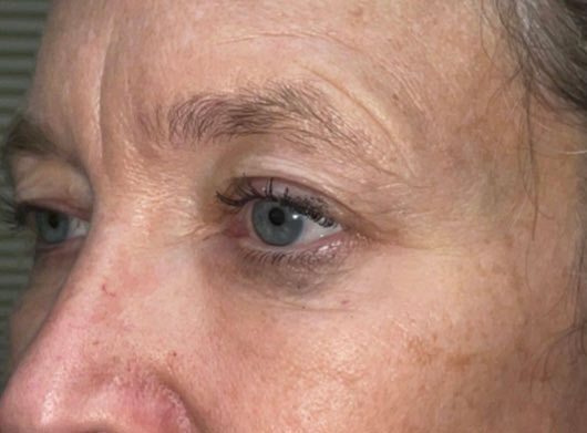 Eyelid Lift (blepharoplasty/ptosis repair)
