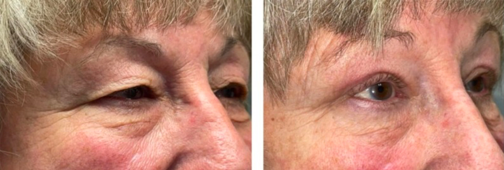 Ptosis &Amp; Droopy Eyelid 1 Ptosis & Droopy Eyelid before and after patient