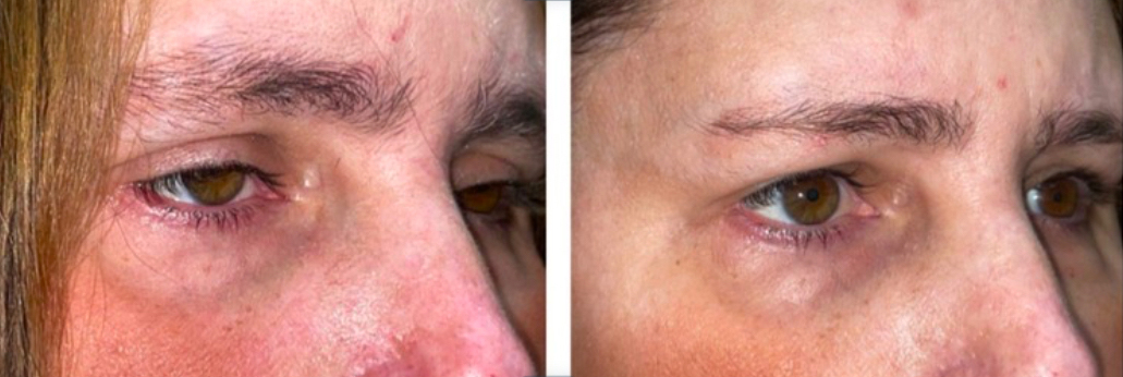 Ptosis &Amp; Droopy Eyelid 2 Ptosis & Droopy Eyelid before and after patient