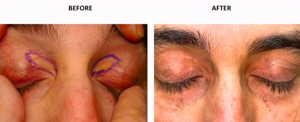 Xanthelasmas patient