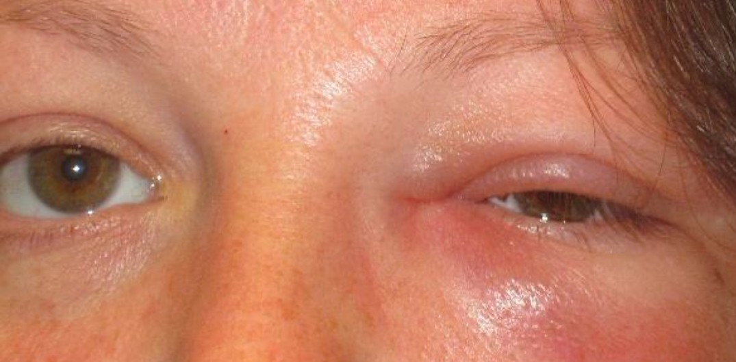 Blocked Tear Duct 2 congenital obstruction pagtient