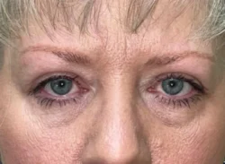 Combination Surgeries (eyelid lift and other)
