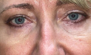After Lower Blepharoplasty Front View
