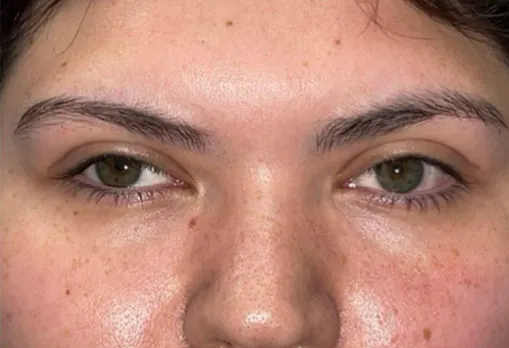 Eyelid Lift (Blepharoplasty/Ptosis Repair)