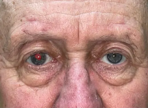 Eyelid Lift (Blepharoplasty/Ptosis Repair)