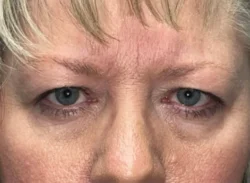 Combination Surgeries (eyelid lift and other)