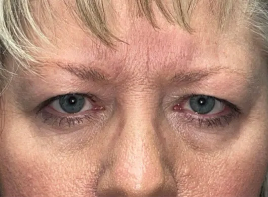 Combination Surgeries (eyelid lift and other)