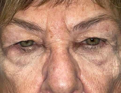 Eyelid Lift (Blepharoplasty/Ptosis Repair)