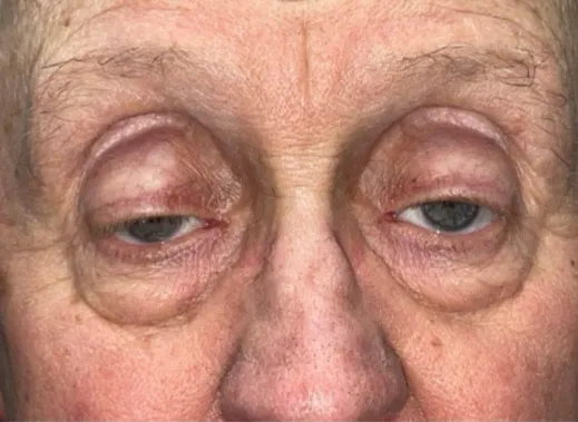 Eyelid Lift (Blepharoplasty/Ptosis Repair)