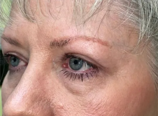 Combination Surgeries (eyelid lift and other)