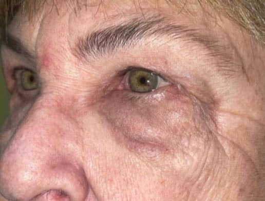 Eyelid Lift (Blepharoplasty/Ptosis Repair)