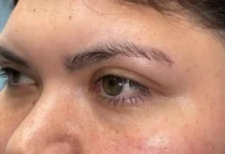 Eyelid Lift (Blepharoplasty/Ptosis Repair)