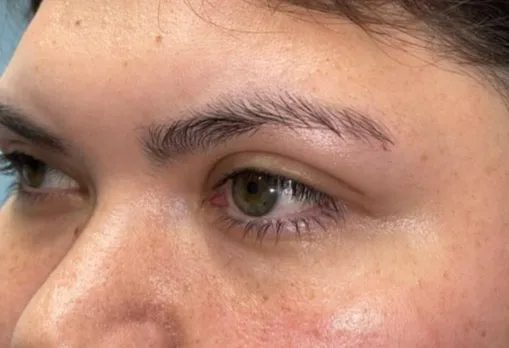 Eyelid Lift (Blepharoplasty/Ptosis Repair)