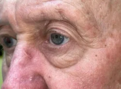 Eyelid Lift (Blepharoplasty/Ptosis Repair)