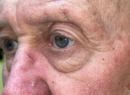 Eyelid Lift (Blepharoplasty/Ptosis Repair)