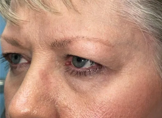 Combination Surgeries (eyelid lift and other)