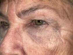Eyelid Lift (Blepharoplasty/Ptosis Repair)