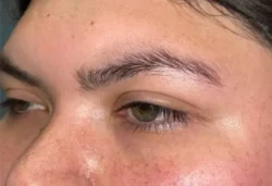 Eyelid Lift (Blepharoplasty/Ptosis Repair)