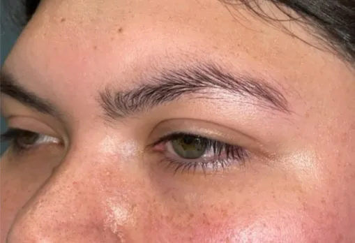 Eyelid Lift (Blepharoplasty/Ptosis Repair)