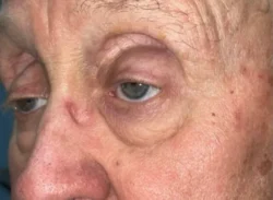 Eyelid Lift (Blepharoplasty/Ptosis Repair)
