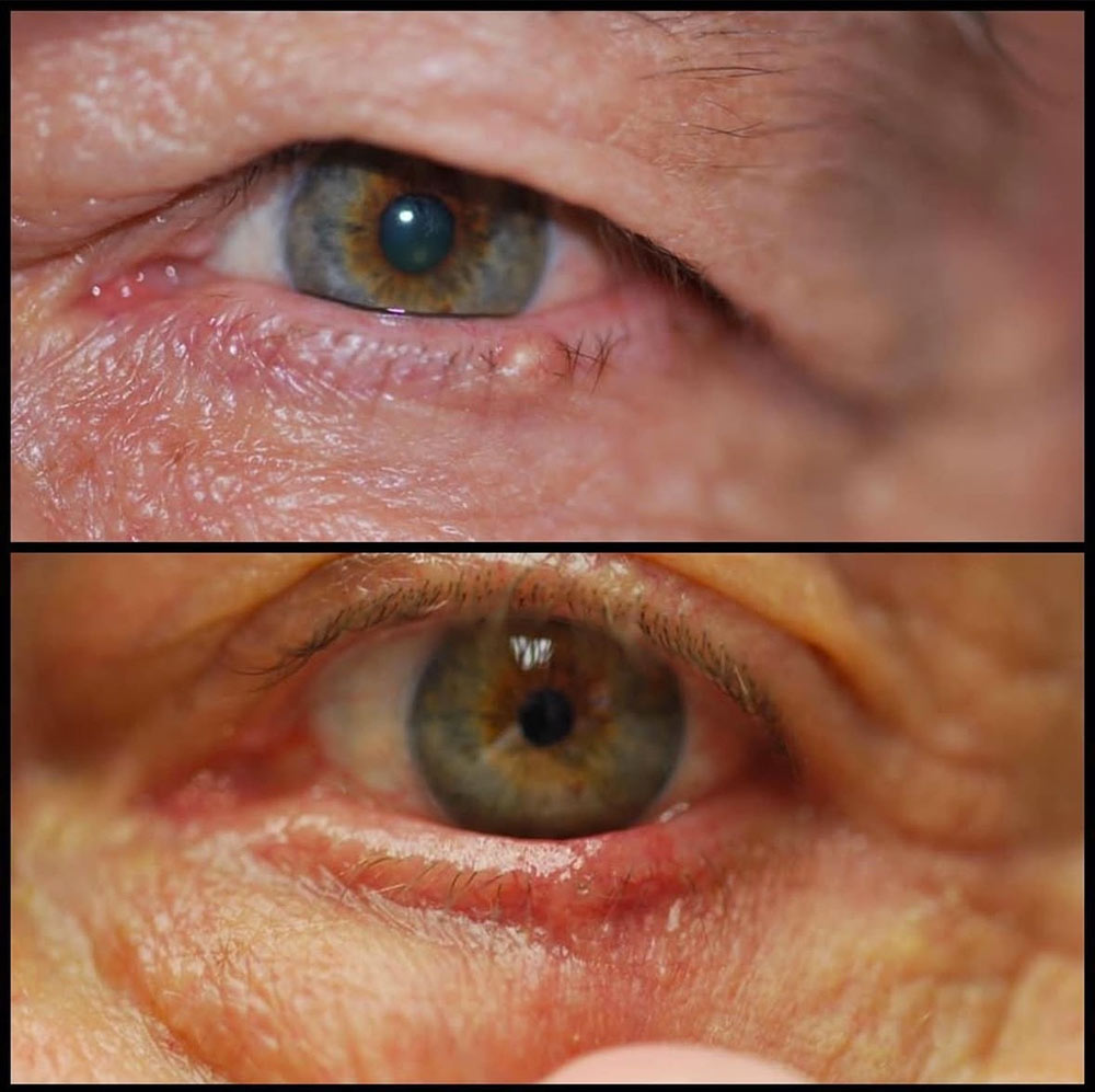 Malignant Lesions 1 malignant lession before and after