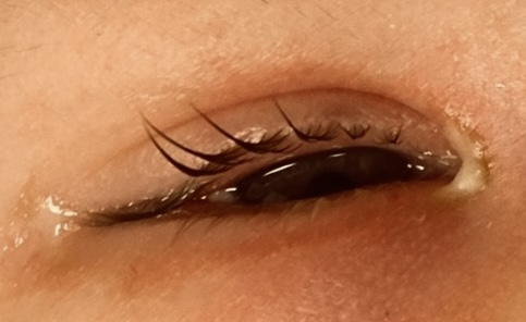Blocked Tear Duct 1 obstructed tear ducts patient