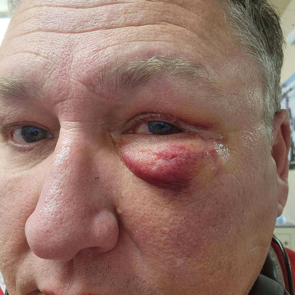 Orbital Trauma 1 Orbital Trauma Patient