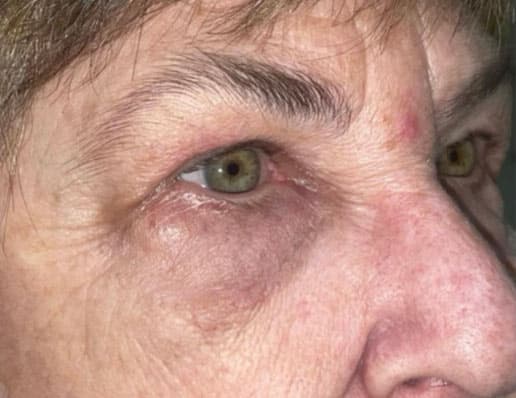 Eyelid Lift (Blepharoplasty/Ptosis Repair)