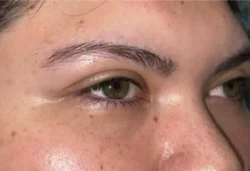 Eyelid Lift (Blepharoplasty/Ptosis Repair)
