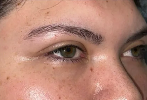 Eyelid Lift (Blepharoplasty/Ptosis Repair)