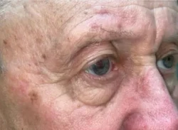 Eyelid Lift (Blepharoplasty/Ptosis Repair)