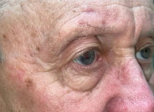Eyelid Lift (Blepharoplasty/Ptosis Repair)