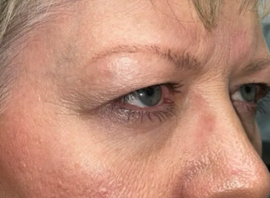 Combination Surgeries (eyelid lift and other)
