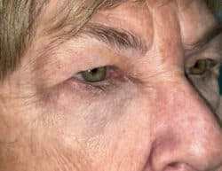 Eyelid Lift (Blepharoplasty/Ptosis Repair)