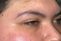 Eyelid Lift (Blepharoplasty/Ptosis Repair)