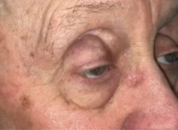 Eyelid Lift (Blepharoplasty/Ptosis Repair)