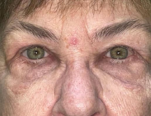 Eyelid Lift (Blepharoplasty/Ptosis Repair)