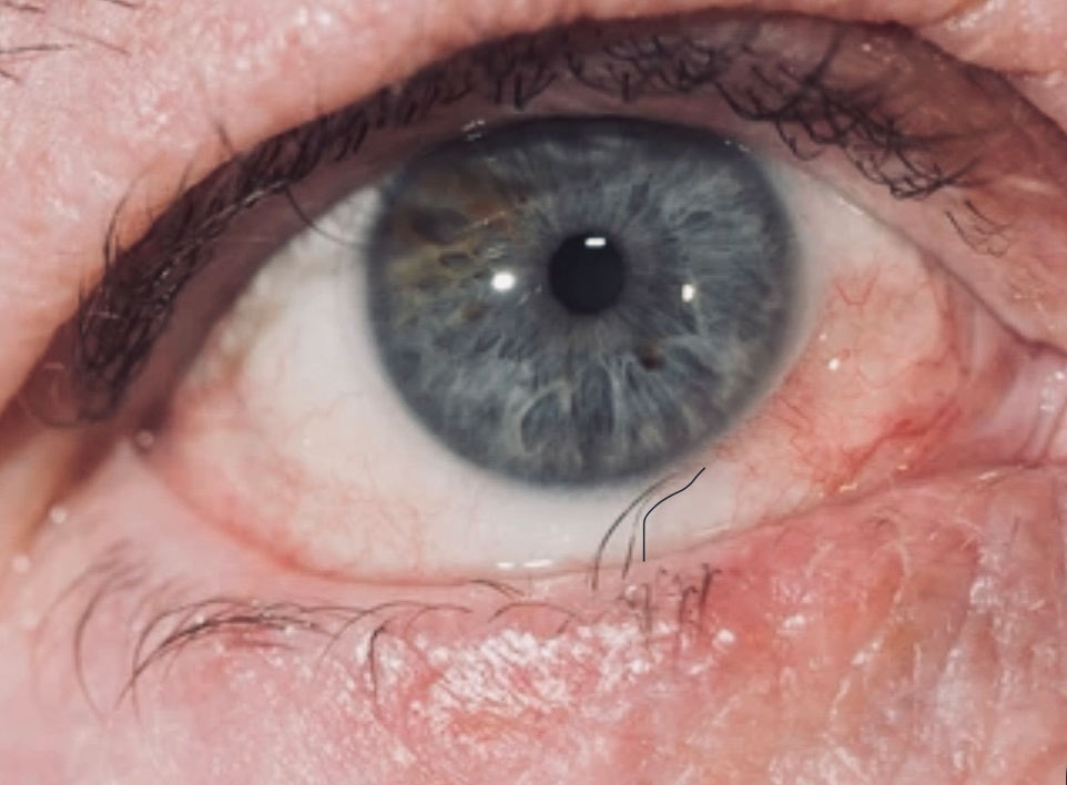 Trichiasis 1 trichiasis patient eye