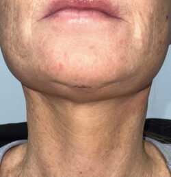 Face/Neck Lift
